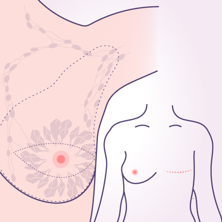 Mastectomy Modified Radical Oncosurgery