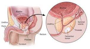 Laser Prostate Surgery