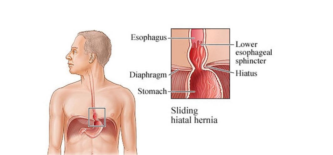 Hiatus Hernia Repair