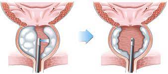 Laser TURP HOLEP