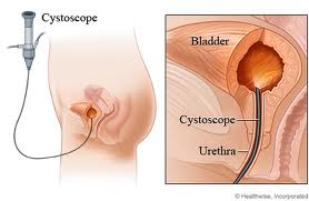 Cystoscopy With Biopsy