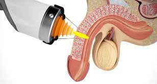Shockwave Therapy For Erectile Dysfunction