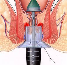 Haemorrhoidectomy Stapled