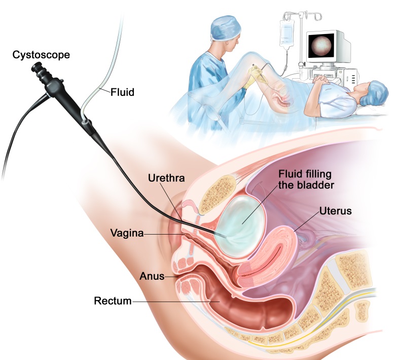 Cystoscopy