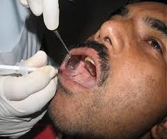 Laser Excision Of Submucous Fibrosis