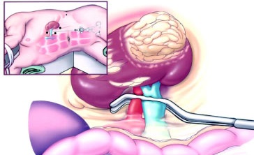 Nephrectomy Partial Laparoscopic