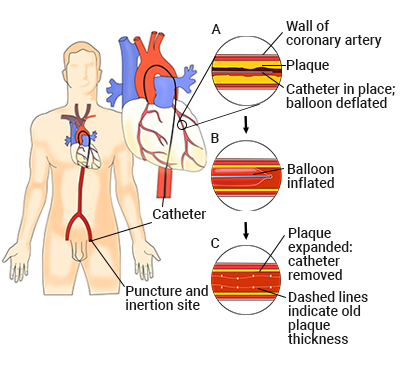 Percutaneous transluminal coronary angioplasty (PTCA)