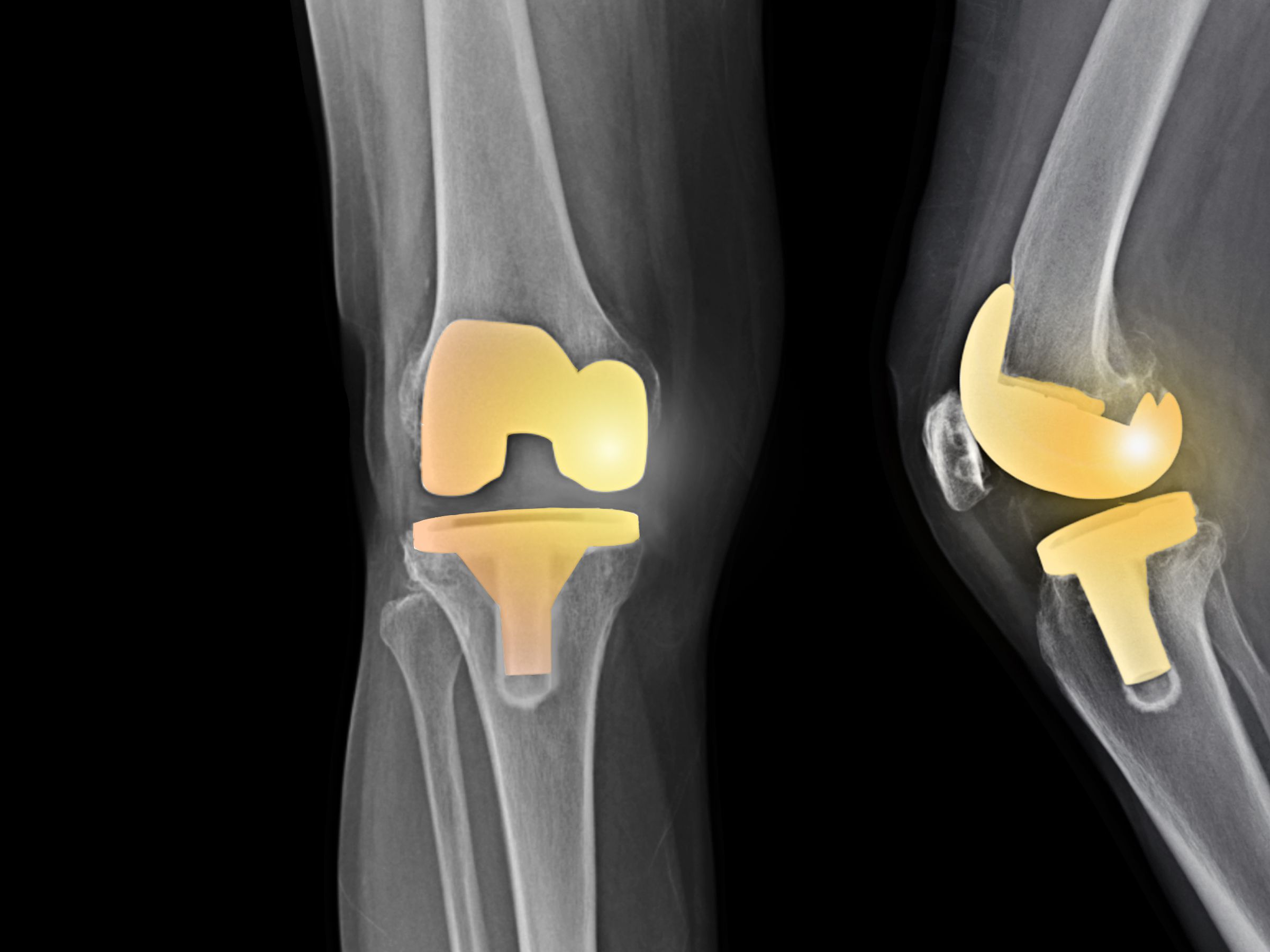 Total Knee Replacement UL