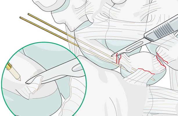 Open Reduction Dislocation Minor