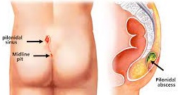 Pilonidal Sinus Treatment
