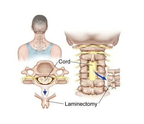 Laminectomy
