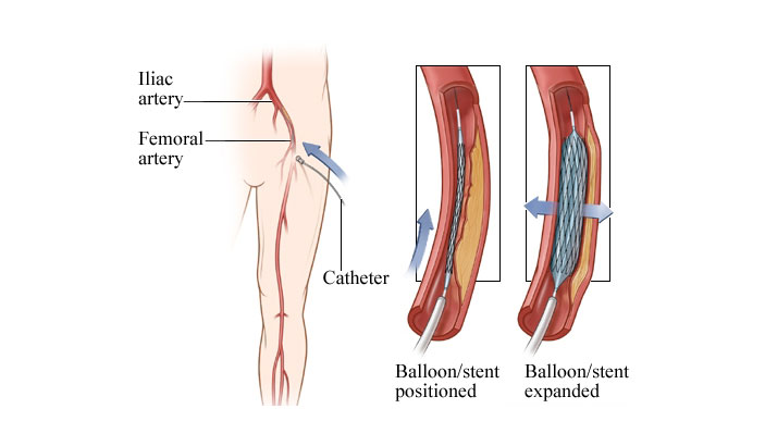 Peripheral Angioplasty