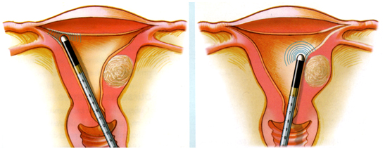Microwave Endometrial Ablation
