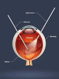 Vitrectomy
