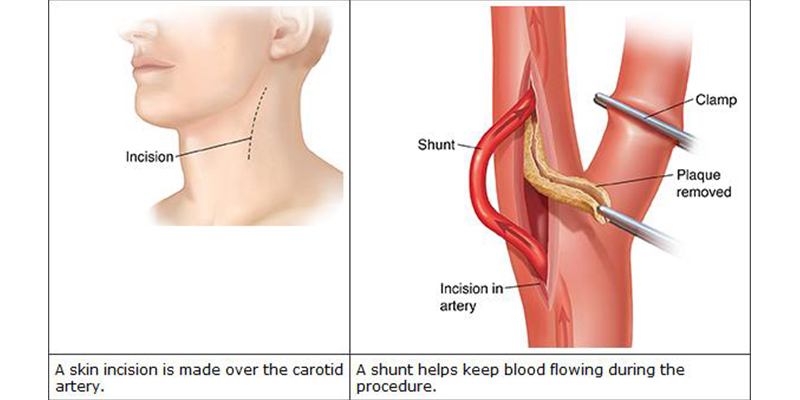 TCAR - Transcarotid Artery Revascularization