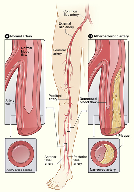 Peripheral Angiography