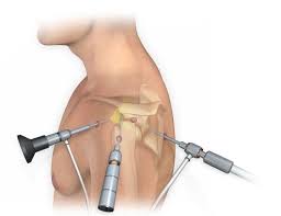 Arthroscopic Shoulder Surgery