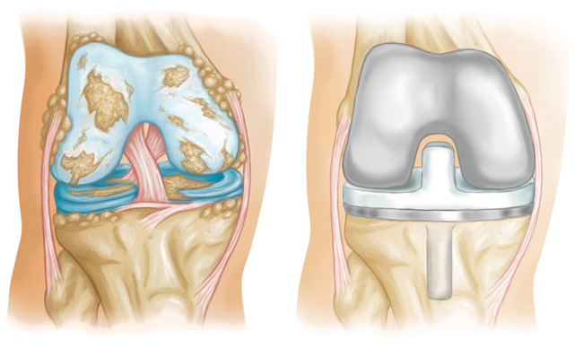 Minimally Invasive Knee Replacement Surgery