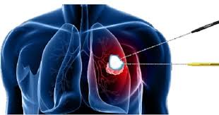 Simple Cryo Ablation