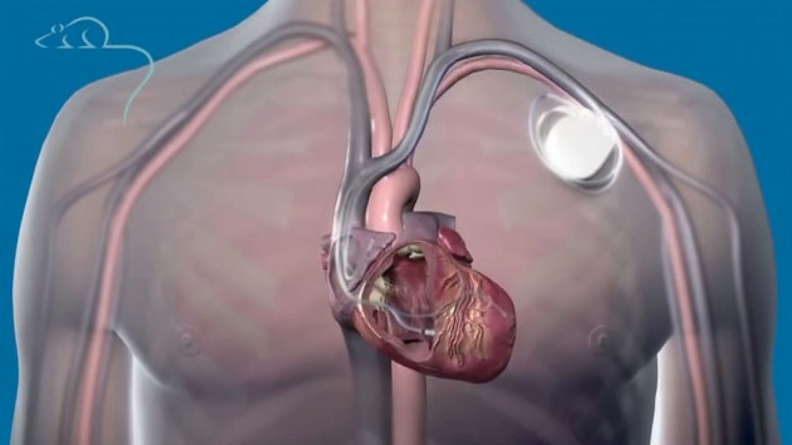 Biventricular Pacemaker Surgery