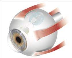 Ahmed Glaucoma Valve