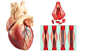 Two vessel angioplasty