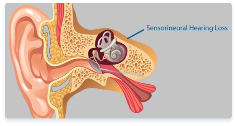 Cochlear Implant Bilateral