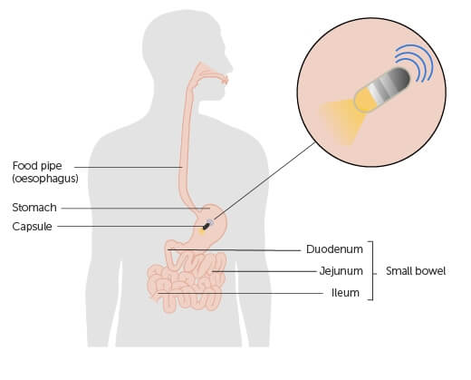 Capsule Endoscopy