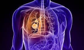 Lung Cancer Treatment