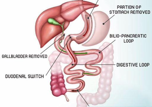 Duodenal Switch