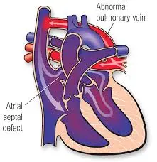Total Anomalous Pulmonary Venous Connection (TAPVC)