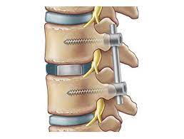 TLIF (Transforaminal Lumbar Interbody Fusion)