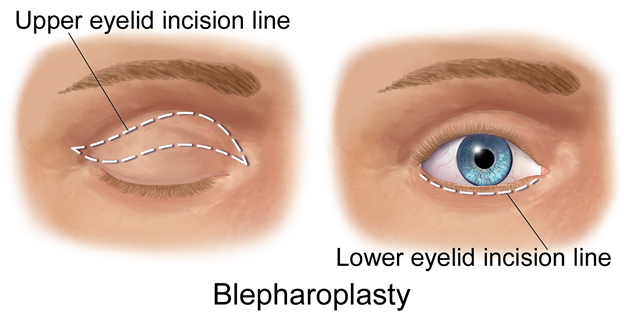 Blepharoplasty (Eyelids)