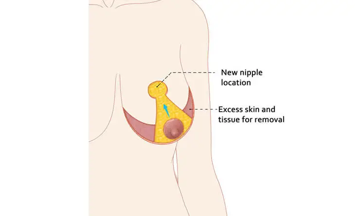 Breast Liposuction
