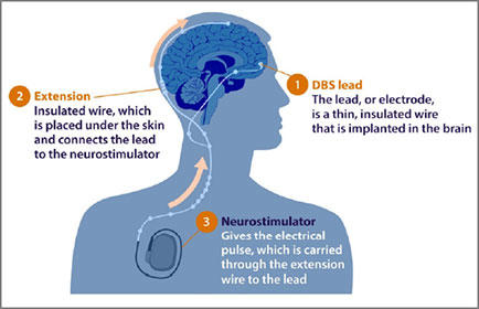 Deep Brain Stimulation - Non-Rechargeable Implant