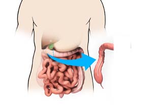 Hemicolectomy