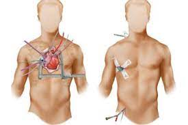 Triple Valve Replacement or Repair