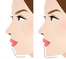 Chin Implant