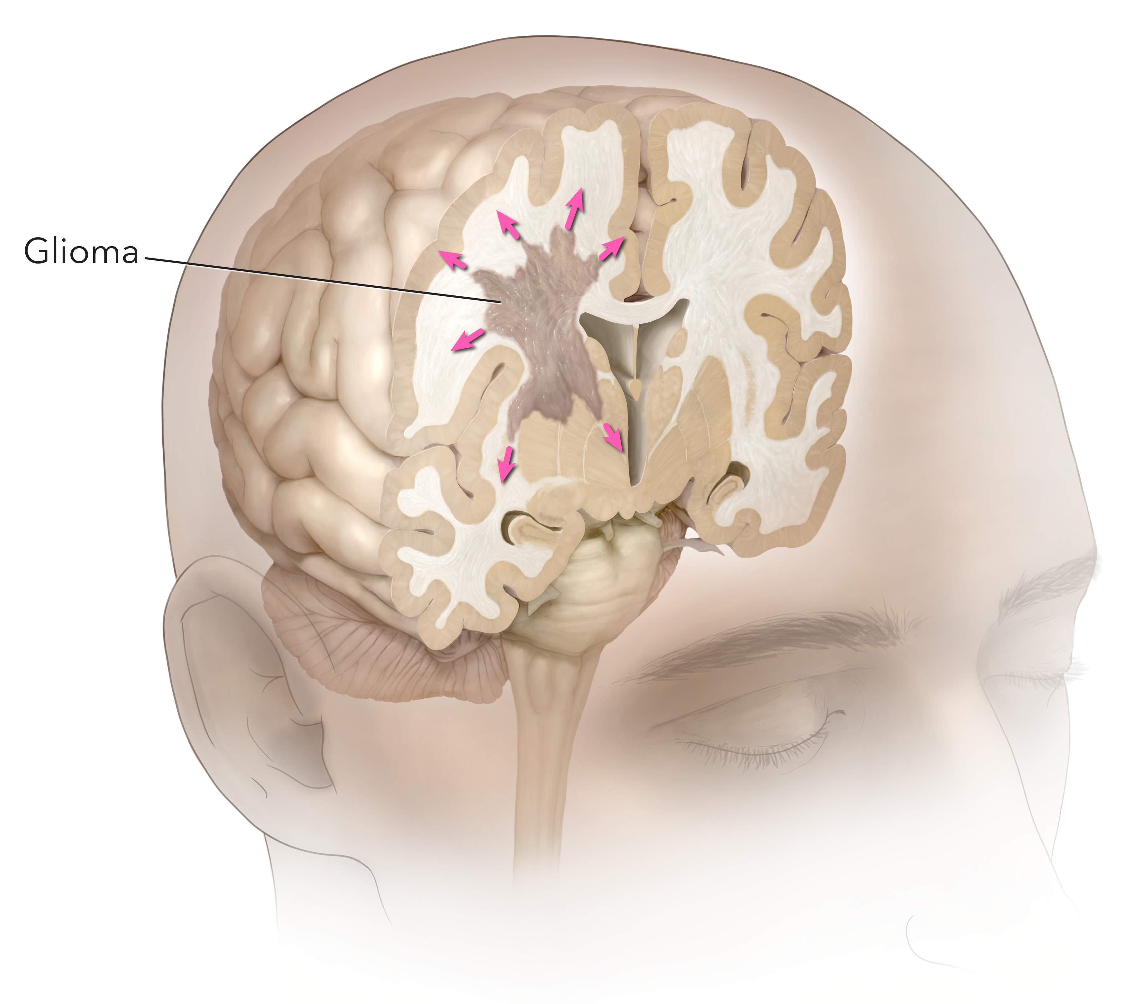 Gliomas Treatment