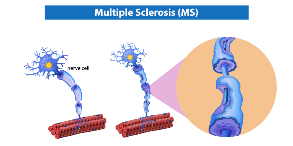 Multiple Sclerosis Treatment