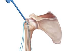 Shoulder Tendon Repair-Rotator Cuff