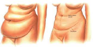 Tummy Tuck
