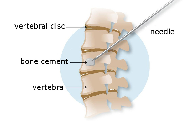 Vertebroplasty