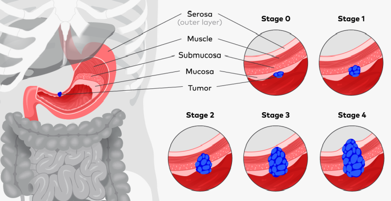 Gastric Cancer Treatment