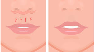 Lip Lift