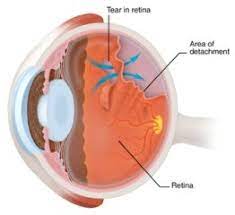 Retinal Detachment Surgery