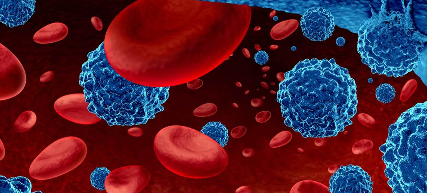 Bone Marrow Transplant Allogenic