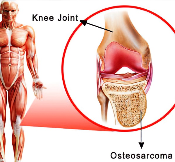 Osteosarcoma (OS) Treatment
