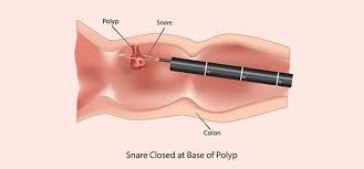 Polypectomy