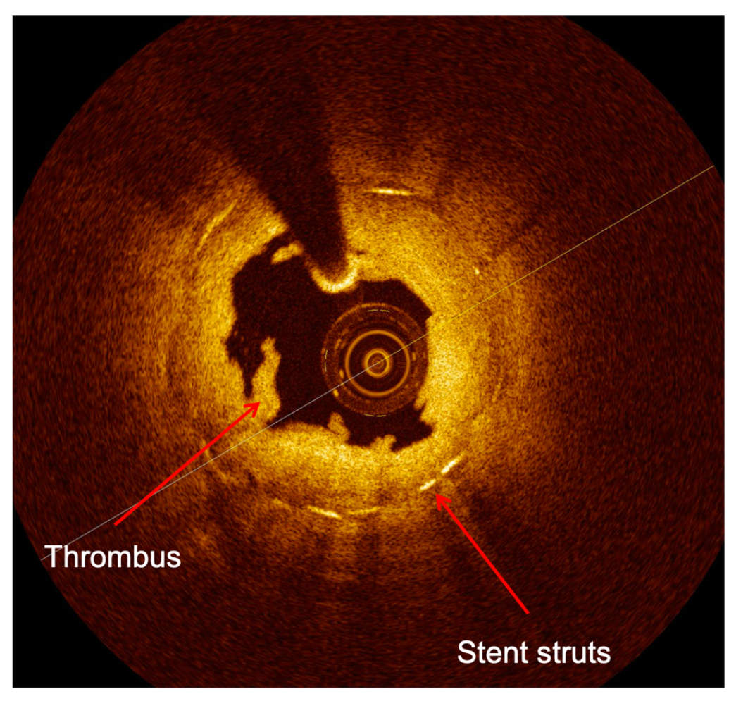 OCT (Optical Coherence Tomography)